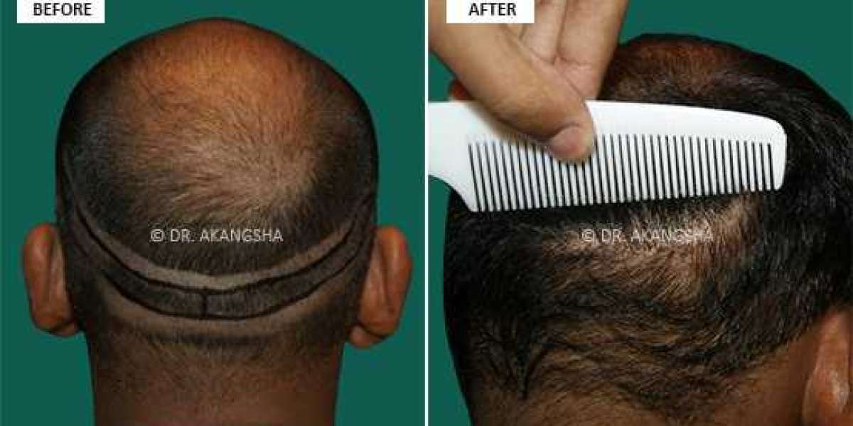 Best Hair Transplant in Jaipur | Hair Transplant Cost in Jaipur