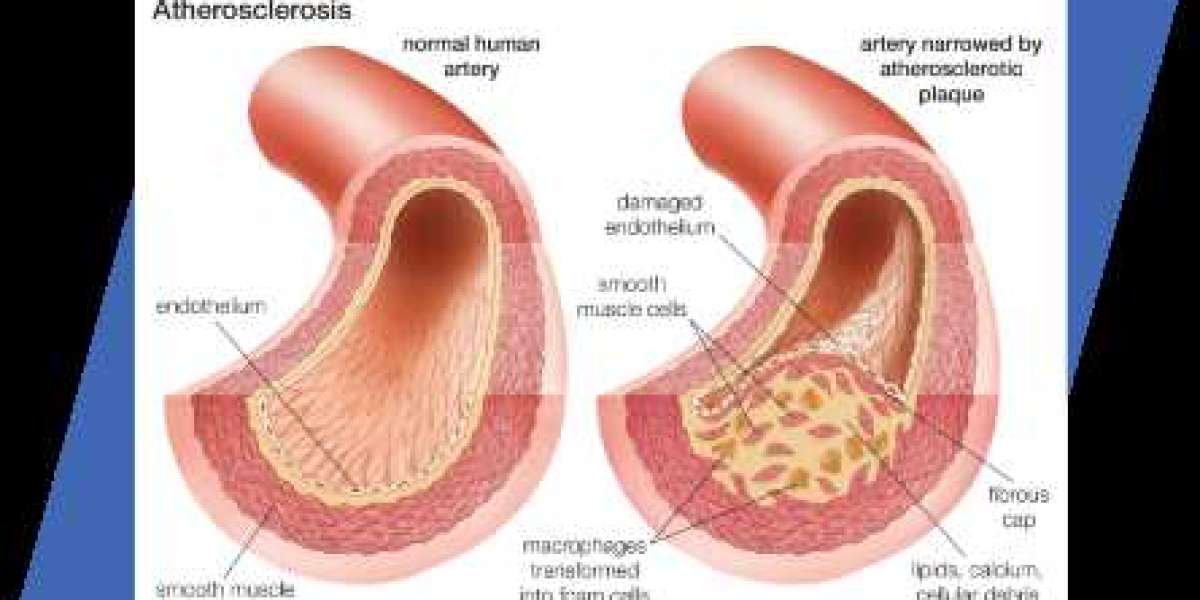 high blood pressure treatment