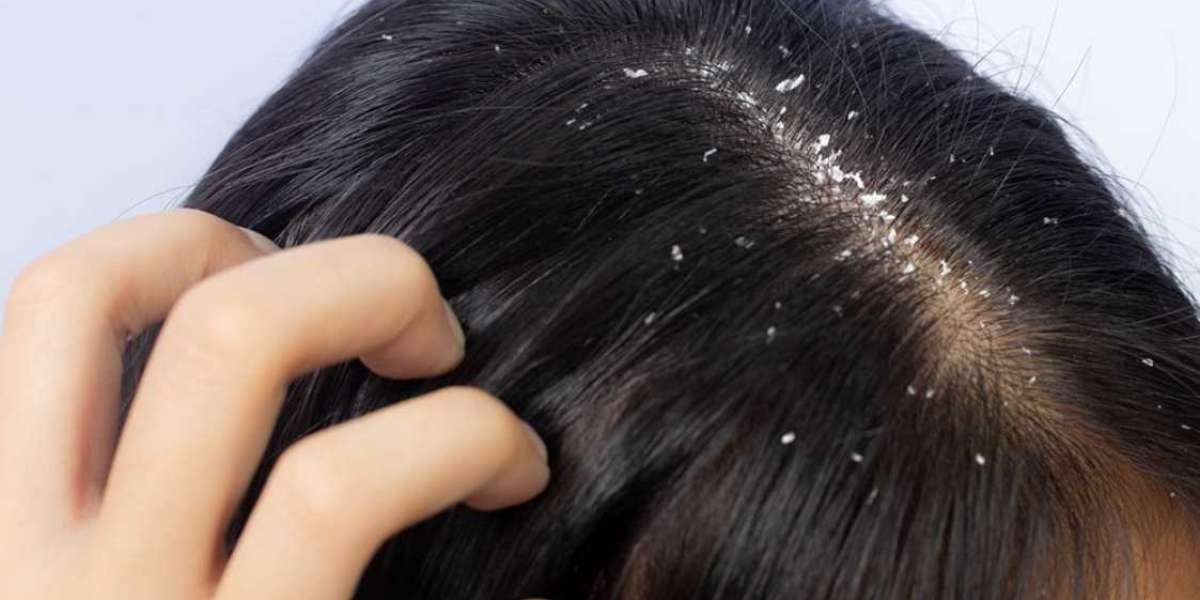 Say Goodbye to Dandruff with These Effective Anti-Dandruff Treatments