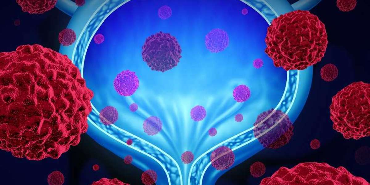 Urothelial Carcinoma Treatment Market Share, Size, Growth, Key Vendors, Trends, Analysis, Segmentation, Forecast To 2022