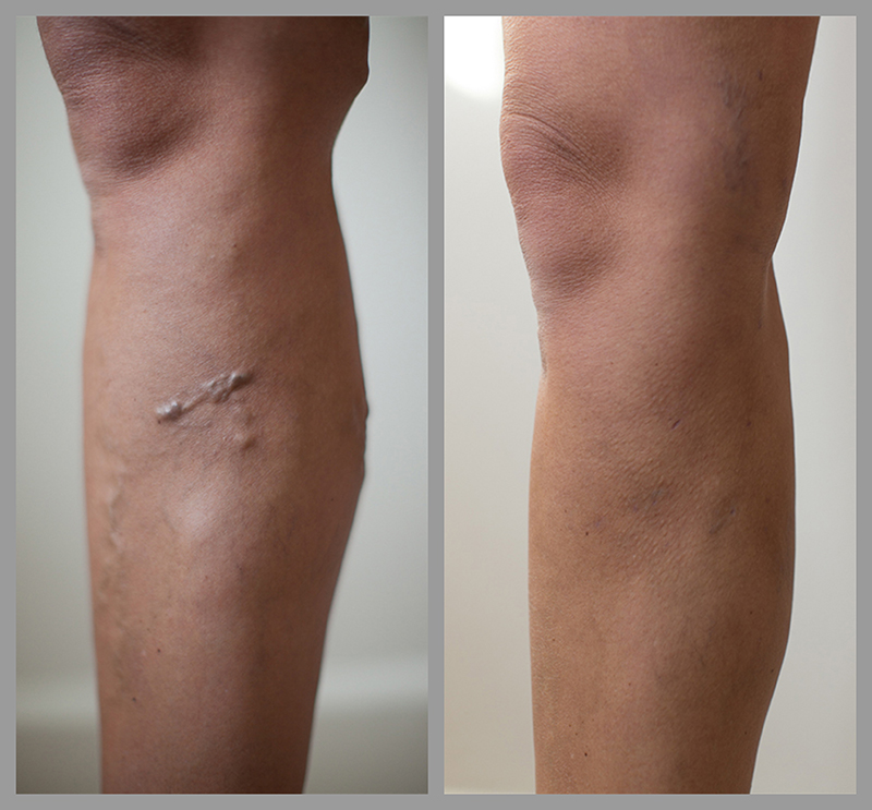 Varicose vein treatment UK – All you wanted to know – Webvk