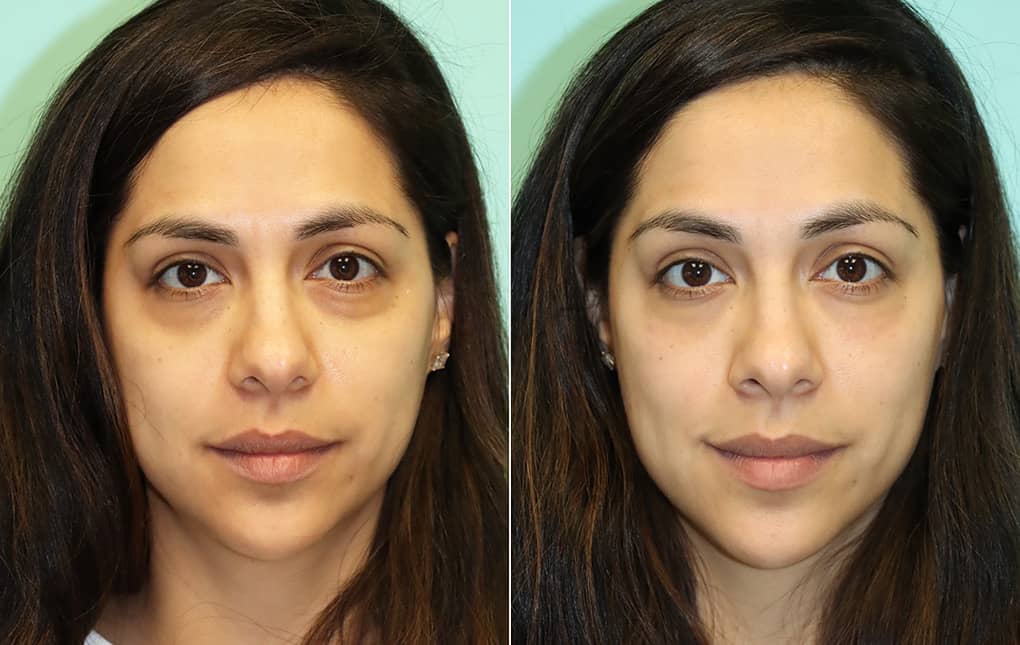 Why should you get tear-trough fillers? – Shop 4 You