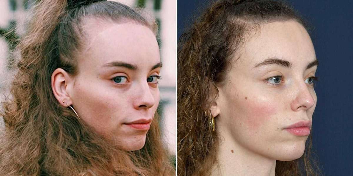 Hairline-lowering surgery
