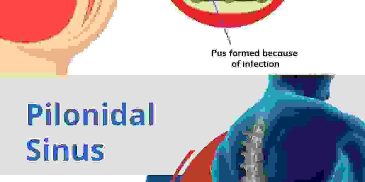 Dr. Tarun Mittal: Revolutionizing Pilonidal Sinus Treatment through Endoscopic Innovation in Delhi