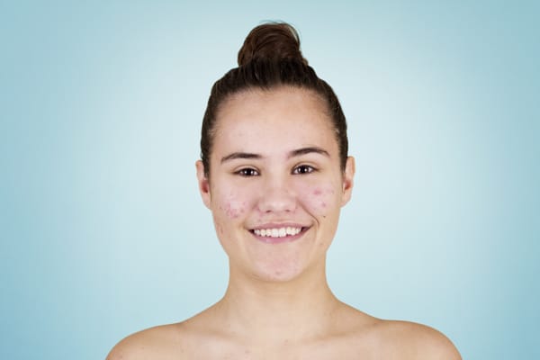 Acne Treatment Market Size, Share, Growth, Trend | Forecast 2032