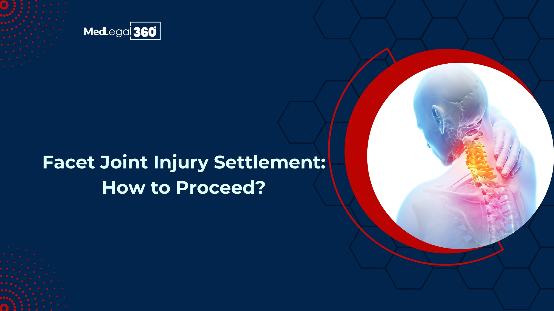 Facet Joint Injury Settlement: How to Proceed?