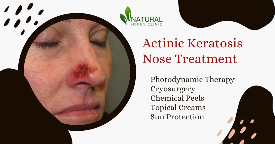 Actinic Keratosis Nose Treatment An Overview of the Latest Strategies