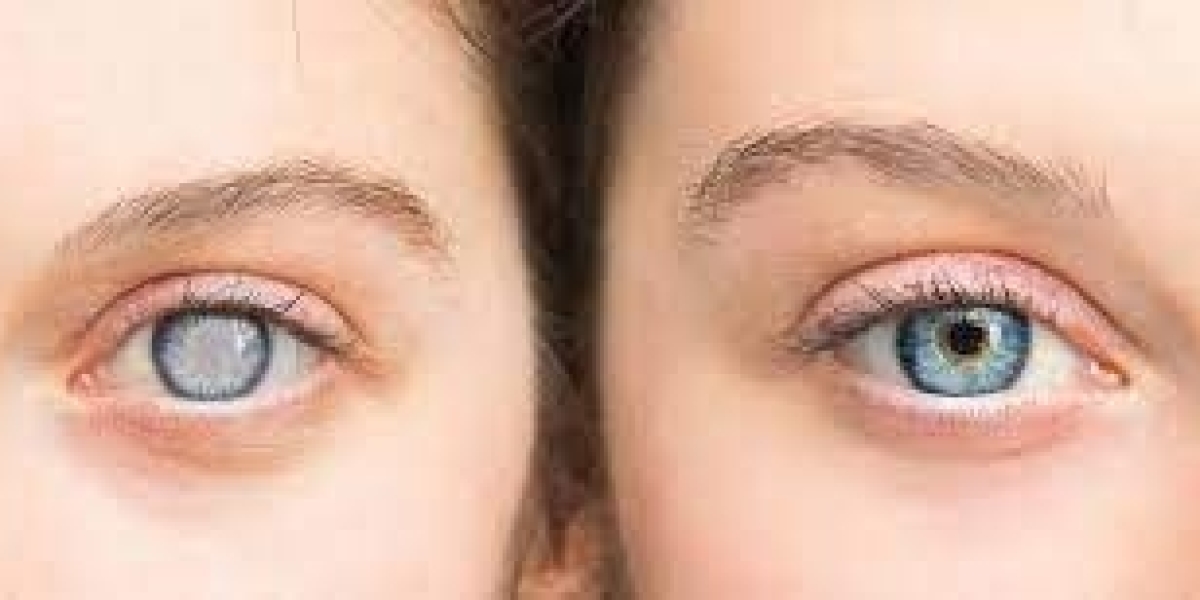 Best Eye Hospital for Cataract Surgery in Delhi