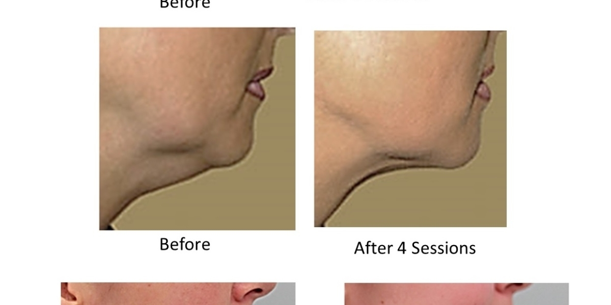 Elevate Your Profile: Double Chin Reduction in Victoria, BC