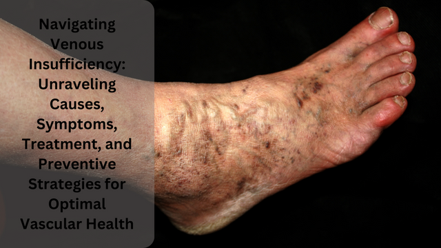 Navigating Venous Insufficiency: Unraveling Causes, Symptoms, Treatment, and Preventive Strategies for Optimal Vascular Health