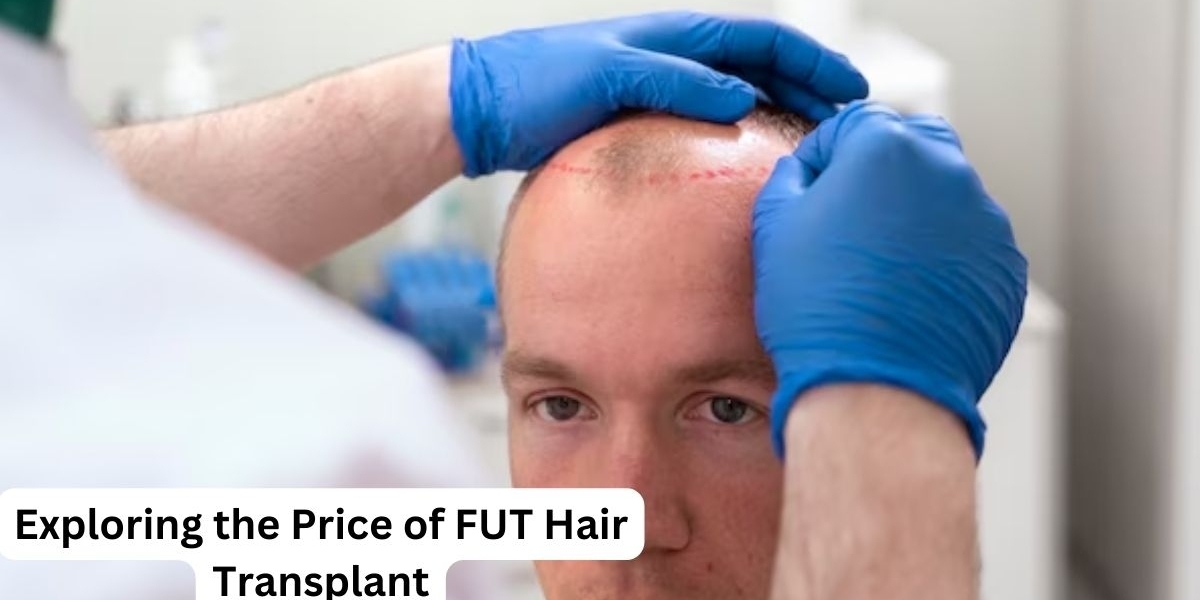 Exploring the Price of FUT Hair Transplant