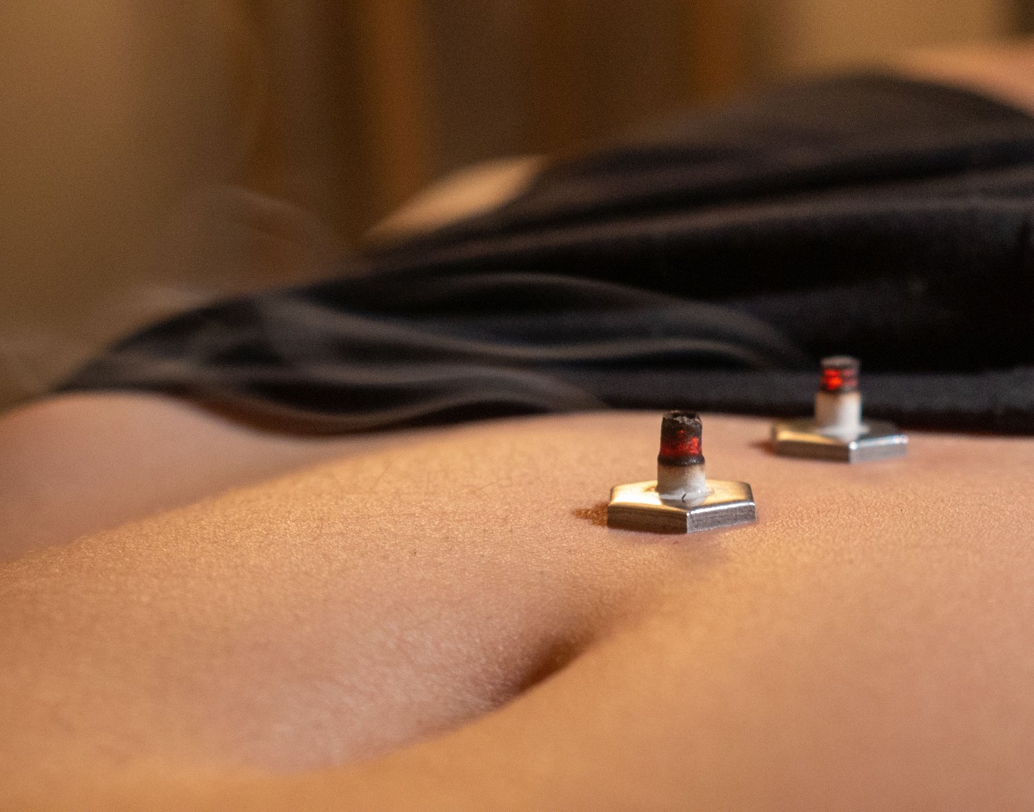 Needle Therapy: The Benefits of Acupuncture in New Albany, Ohio - Fyberly