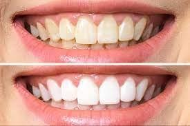Unlock Your Brightest Smile with Crest Teeth Whitening ...