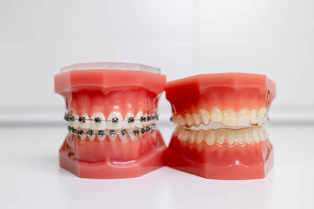 Which One Is Right For You, Invisalign Vs. Traditional Braces? – Telegraph