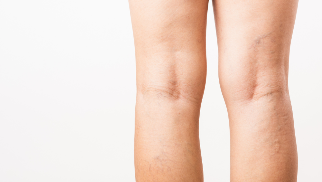 When Are You At Greatest Risk Of Varicose Veins - VeinsNet