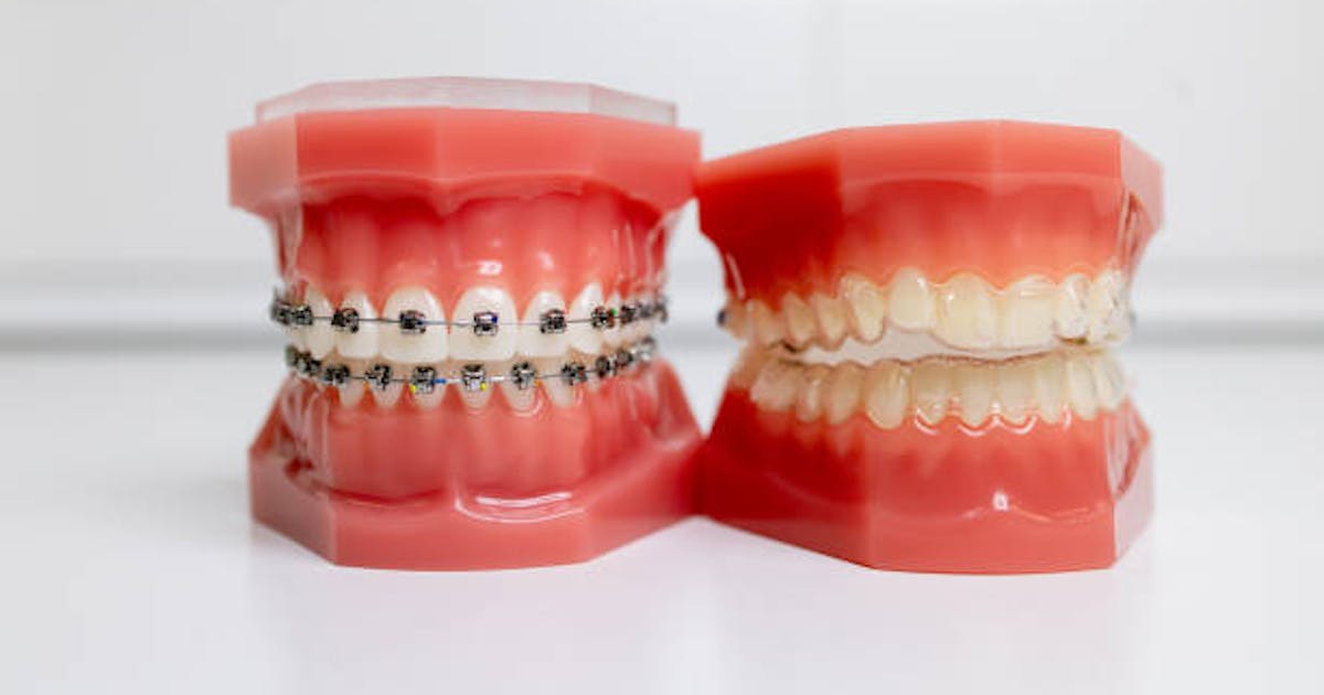 Which One Is Right For You, Invisalign Vs. Traditional Braces?