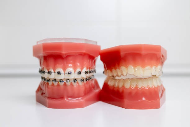 Which One is Right for You, Invisalign or Braces?