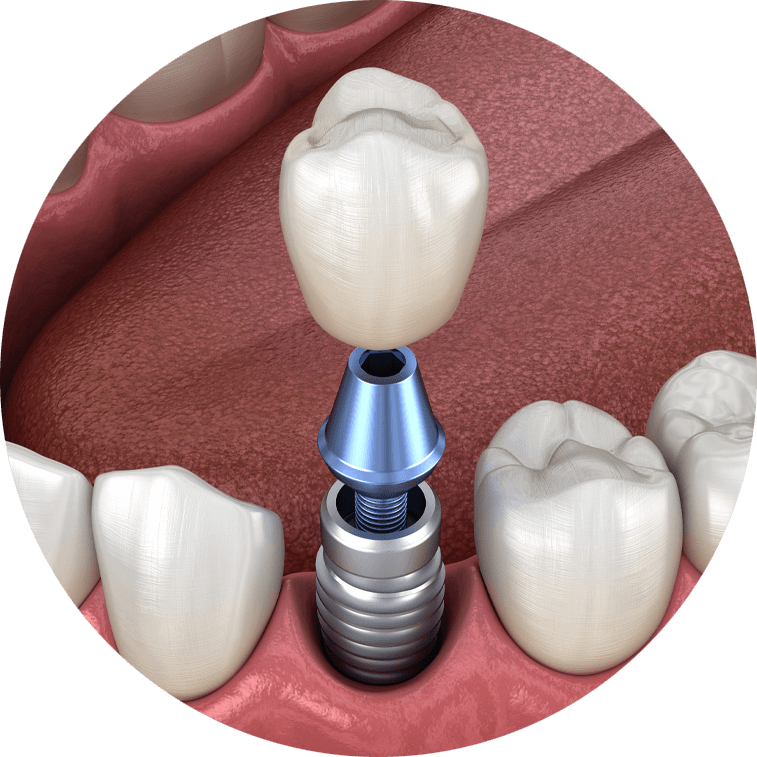 Dental Implants - Face Kraft Clinic