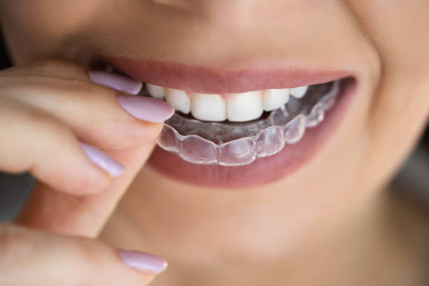 The Clear Alternative to Braces – Invisalign