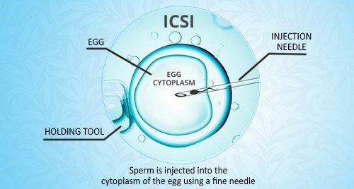 IVF with ICSI in Delhi - ICSI Center in Delhi - Dr. Rupali Bassi