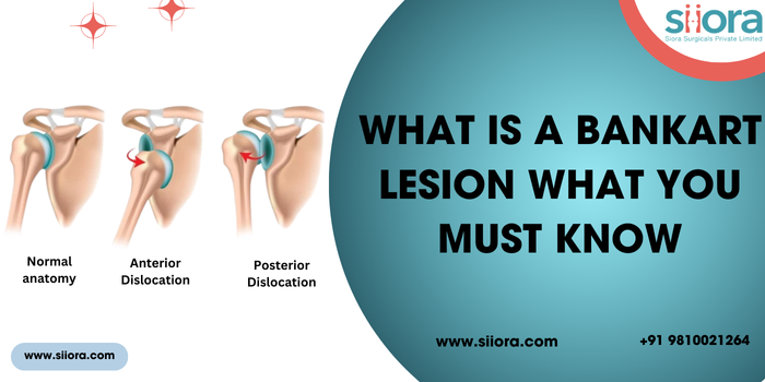 What is a Bankart Lesion – What You Must Know? – Orthopedic Implant Company