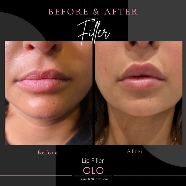 Top Reasons One Should Think About Getting Lip Fillers Vaughan – Glo laser