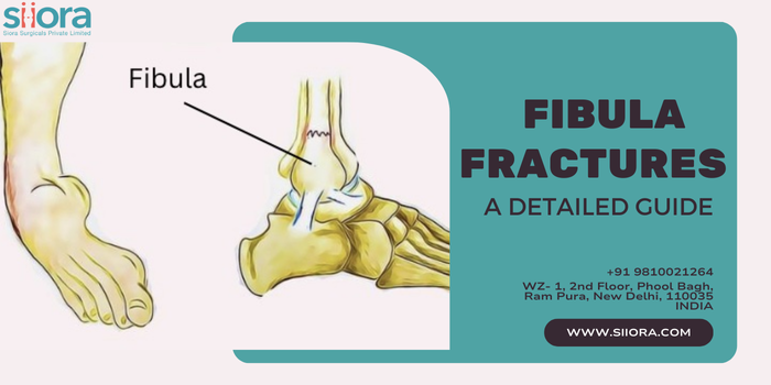 Fibula Fractures - A Detailed Guide