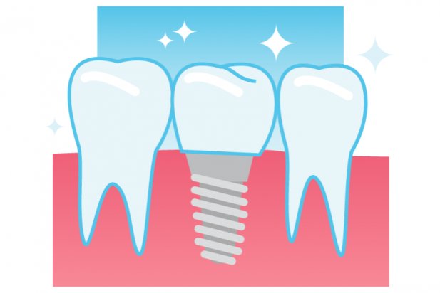 Are Dental Implants Painful? What to Expect During Recovery Article - ArticleTed -  News and Articles