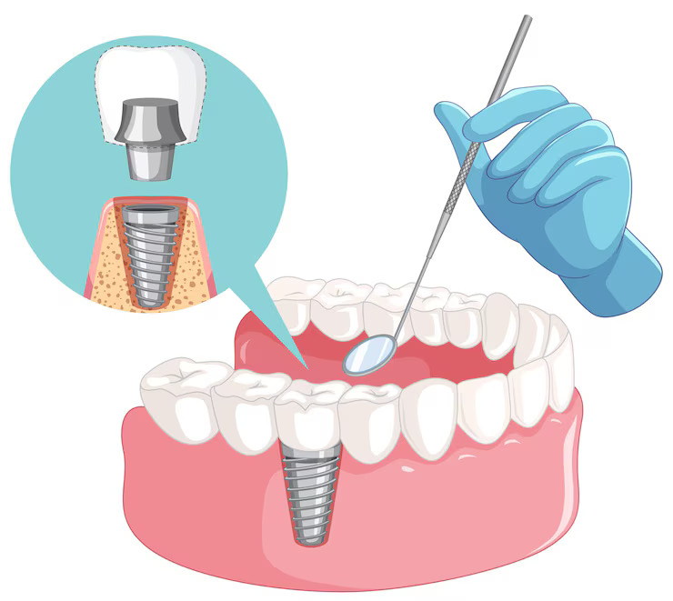 Are Dental Implants Right for You? Factors to Consider Before Choosing Implants