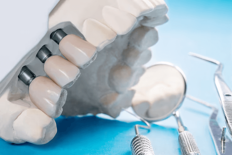 Things You Should Know About Dental Bridges Different Parts that Make Up a Bridge and Varieties of Bridges Available