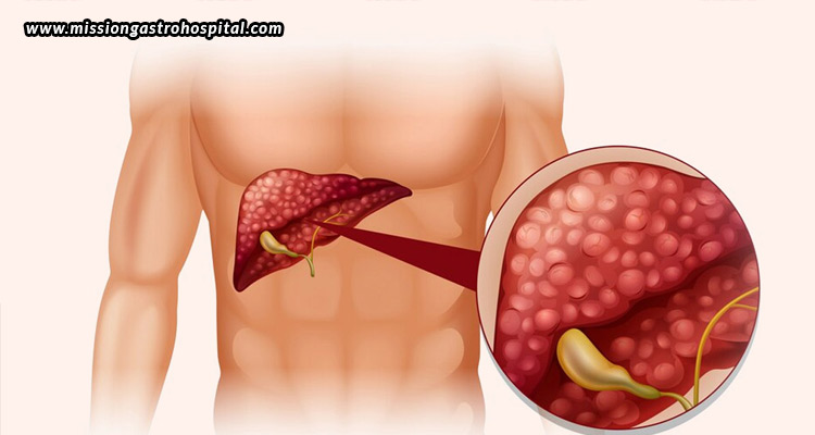 Liver Function Tests (LFTs): What They Reveal About Your Health - Mission Gastro Hospital