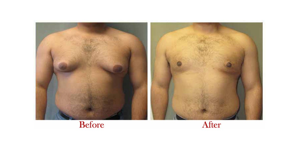 Gynecomastia Surgery in Delhi: A Comprehensive Guide | by Dr. Vivek Kumar | Jan, 2025 | Medium