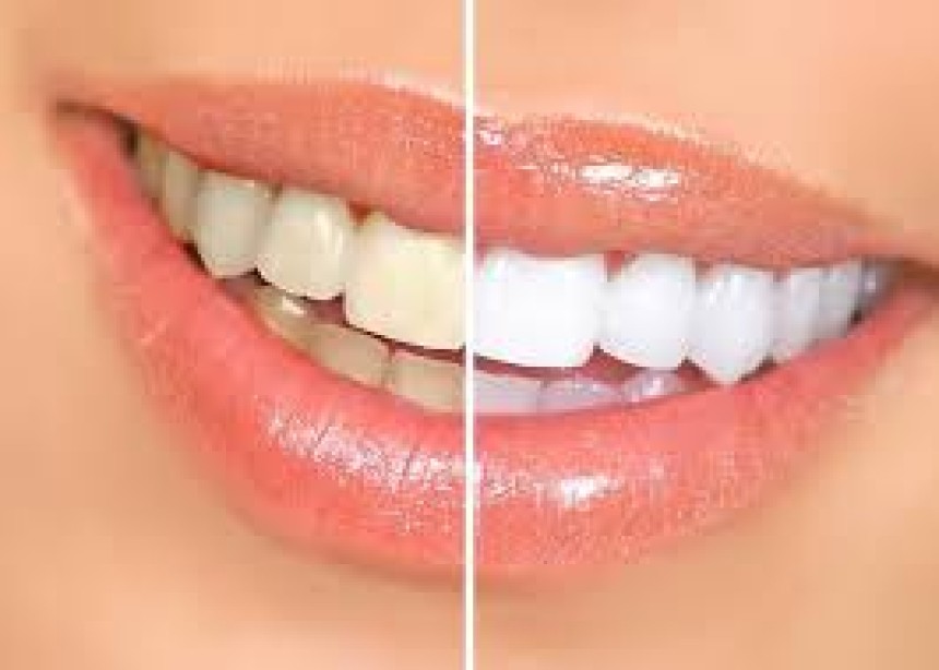 Blogs - Bang Box online - Professional Teeth Whitening vs. At-Home Kits: Which Works Best?