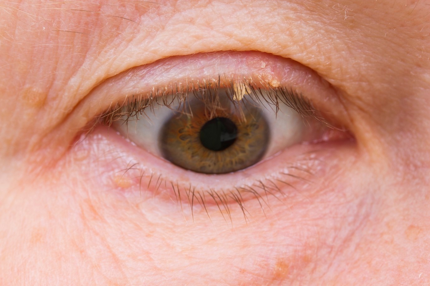 How Do I Remove a Skin Tag on My Eyelid? -