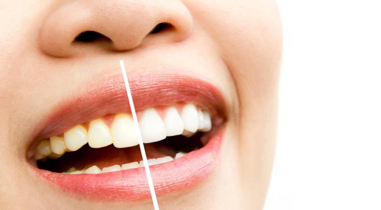 What are the Different Methods Available for Dental Teeth Whitening? - Houston