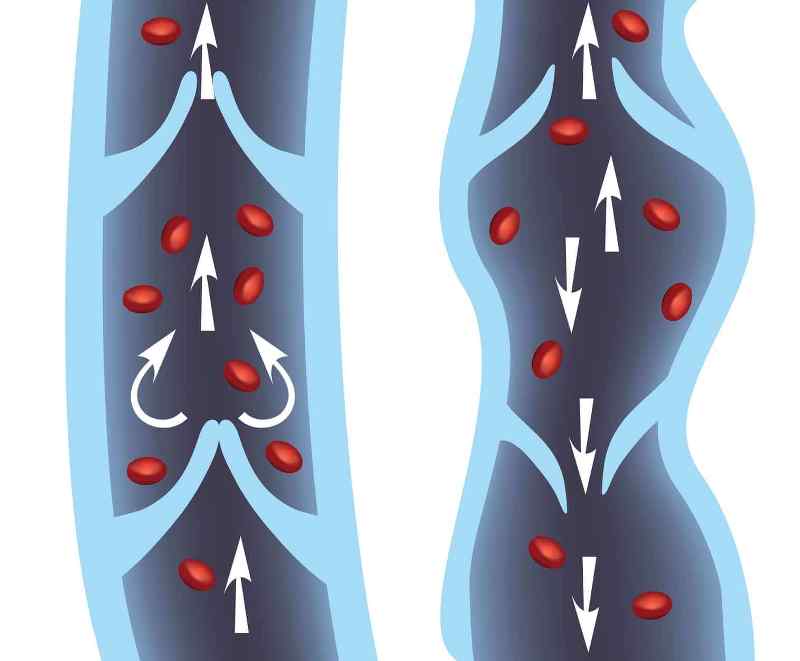 Avail affordable Varicose Vein treatment cost in the UK! | Vipon