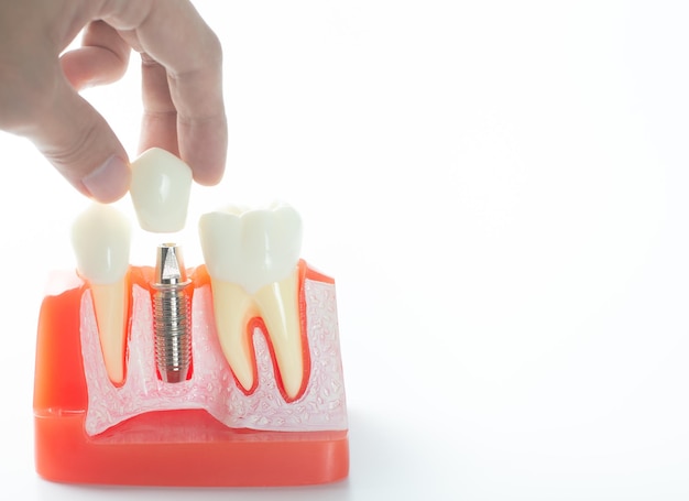 Why You Need a Dental Implant Specialist: Expert Care for Your Smile – Telegraph