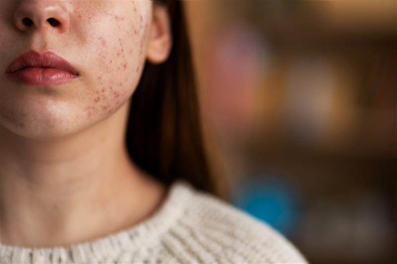 Say Goodbye to Breakouts with Expert Acne Care in Sydney | by Dr Sana Aesthetics | Mar, 2025 | Medium