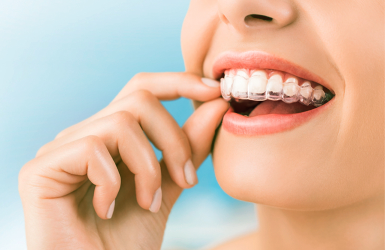 Invisalign Treatment | Clear Aligners | Carolina Smile Dentistry
