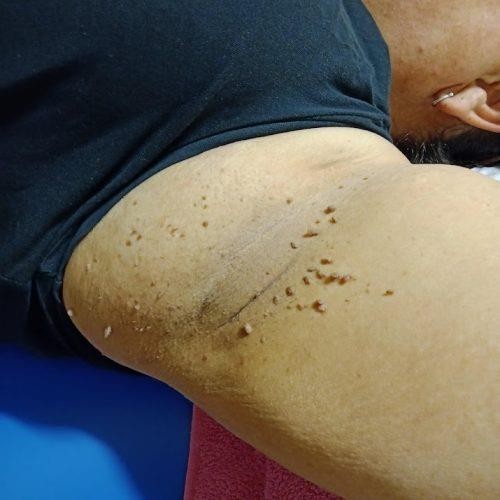 Skin Tag Removal Guide: Simple Steps to Clear Skin