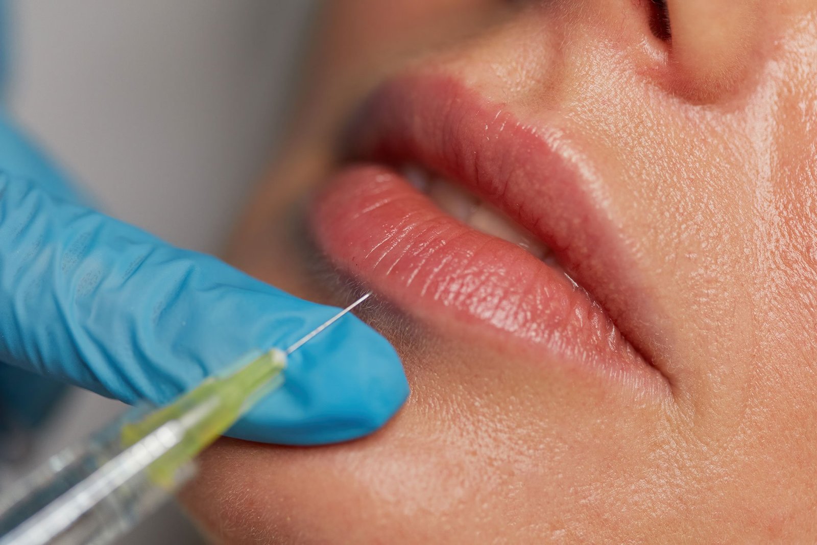 Enhance Your Look with Lip Fillers in Delhi | Sarayu Clinic