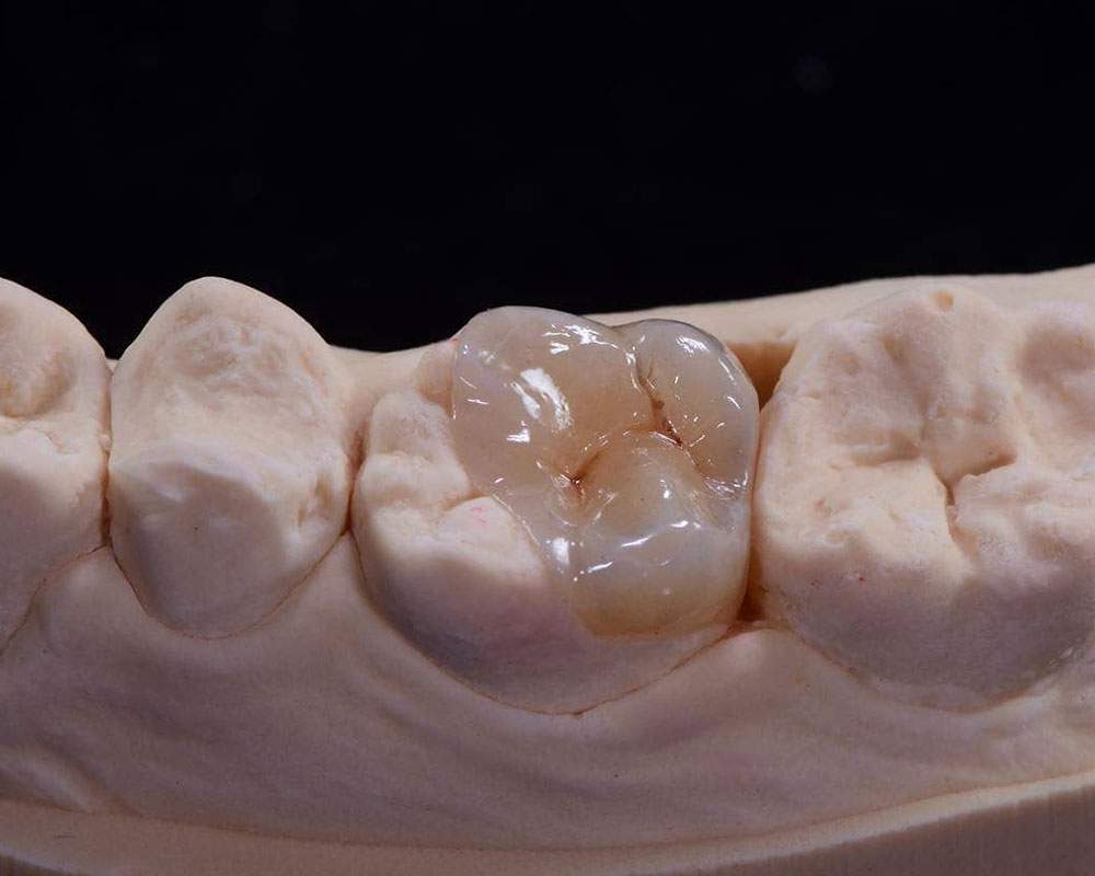 Premium Emax Onlay Supplier - Hy Dental Lab