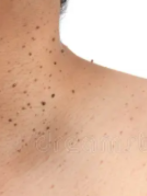 Expert Skin Treatments in Milton Keynes | Call NOW!